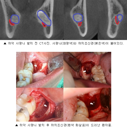 하악 사랑니 발치 시 신경손상 발생 연구…발치 후 신경 노출된 경우 전부 3개월 내 회복